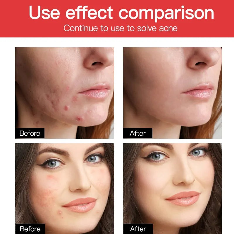 Transparent Acne Acne Stickers Convenient Invisible Day And Night Repair